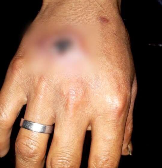  Caserío Palmeras en Alto Saposoa registra 5 casos de Leishmaniasis-UTA